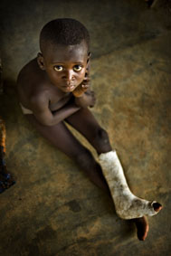 niño 8 años operado pie equino por secuela poliomeilitis_operación 2011
