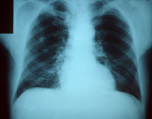radiografía neumonía