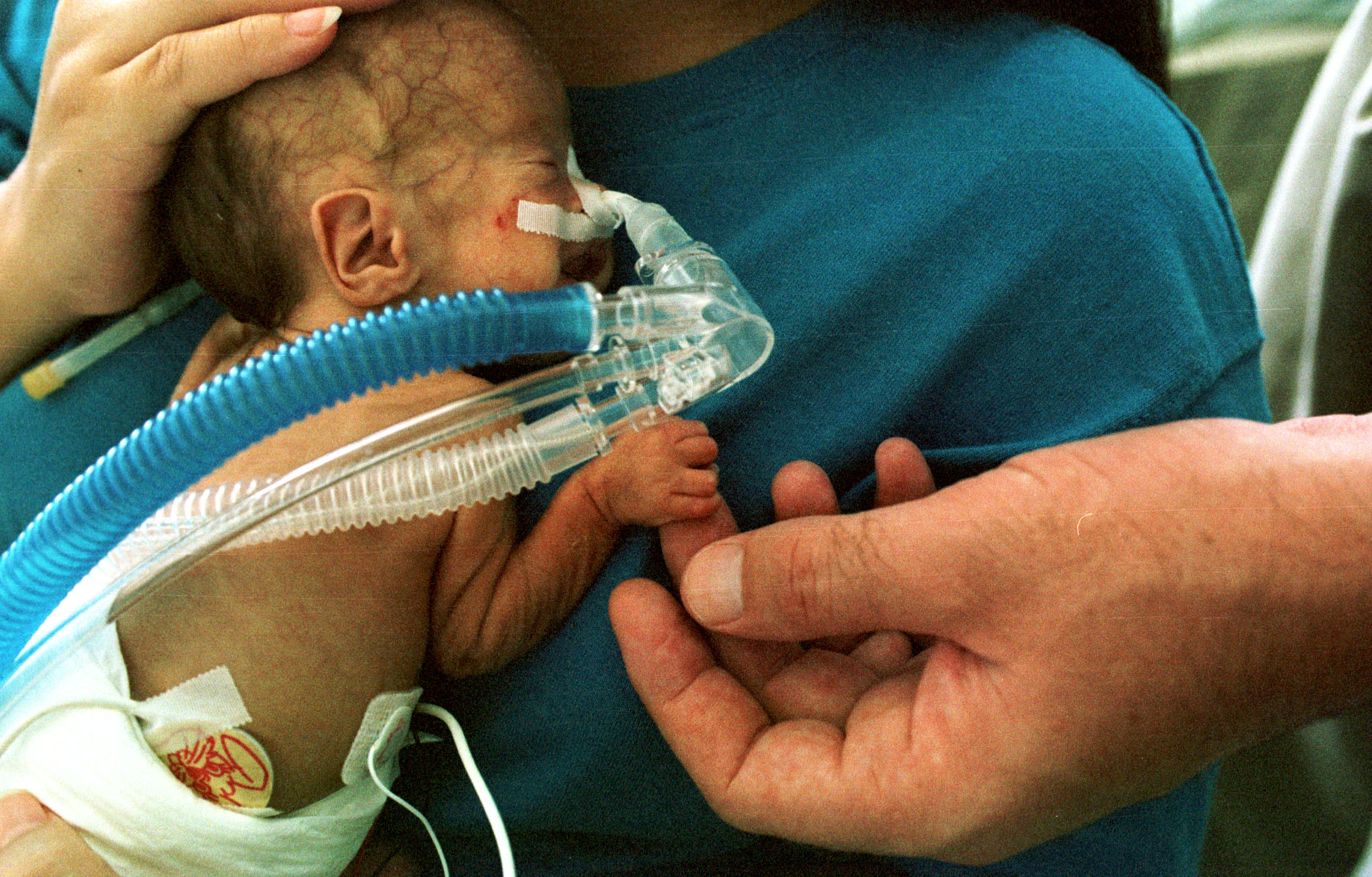 Why Do Premature Babies Develop Slower?